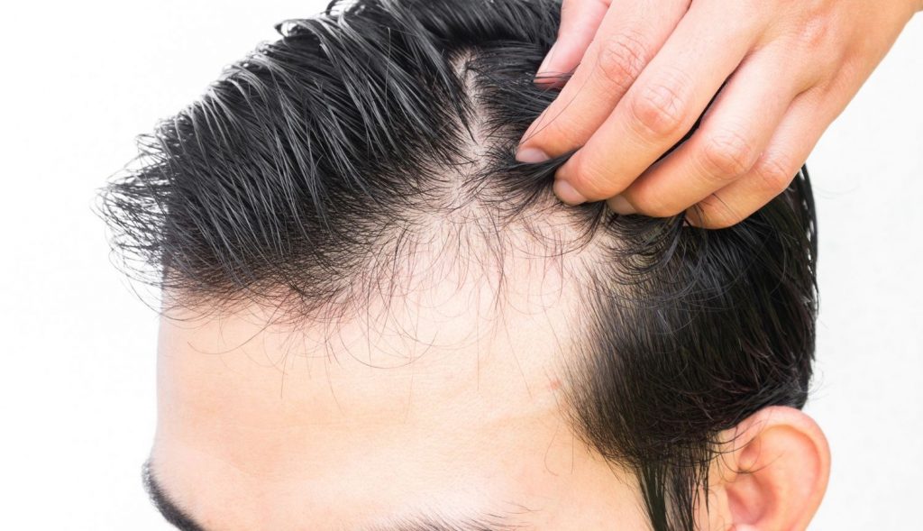 Cómo No Quedarte Calvo: Trucos Para Evitar La Caída Del Pelo