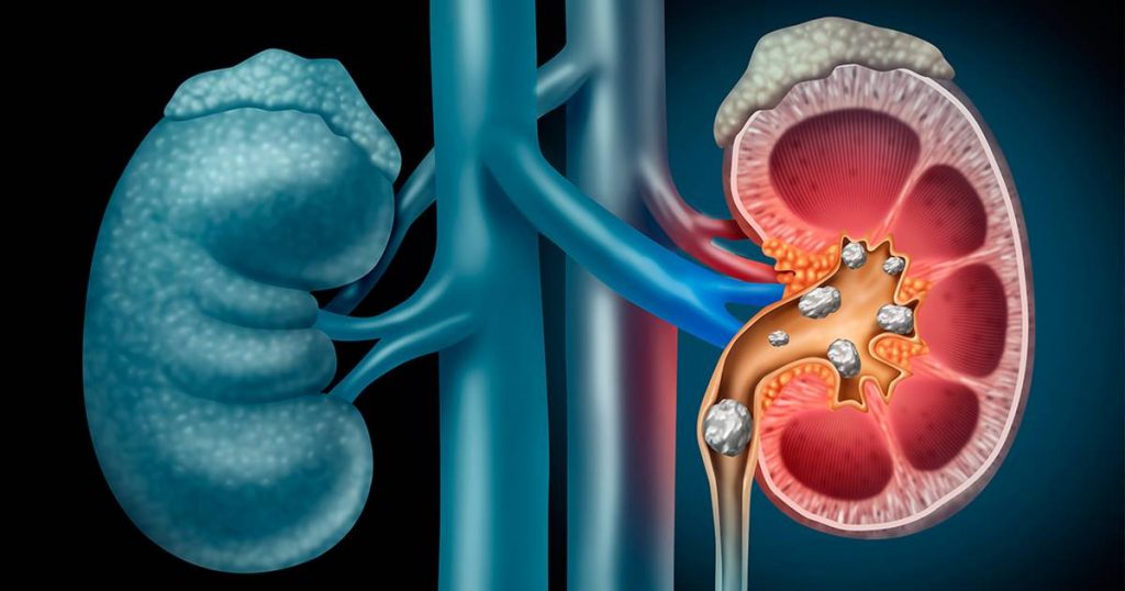 Cómo Expulsar Una Piedra Del Riñón 