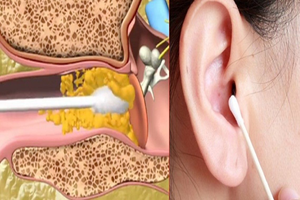 Cómo eliminar la cera de los oídos