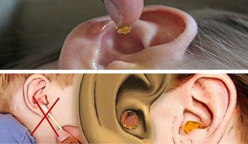 Como Eliminar La Cera De Los Oídos 