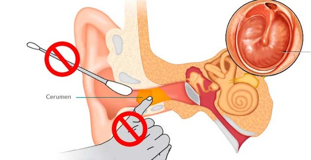 Cuales Son Los Síntomas De La Cera Oídos 