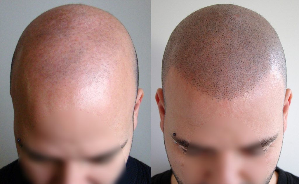 La Isla De Las Tentaciones: El Nuevo 'Look' De Pablo Que Da Carpetazo A Su Vida