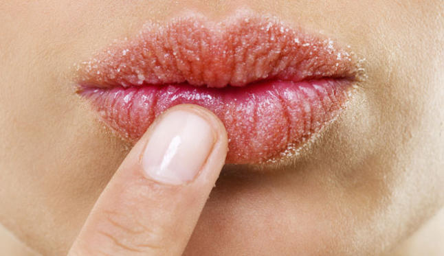Los Labios También Lo Pasan Fatal Con Olas De Frío Como 'Filomena'.