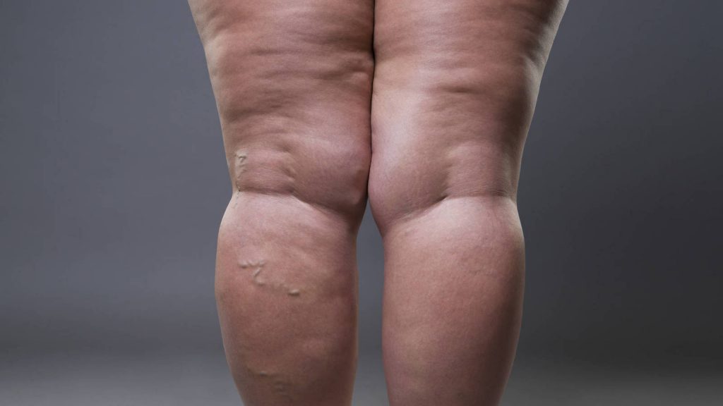 7 Señales Que Te Avisan De Que Te Faltan Proteínas