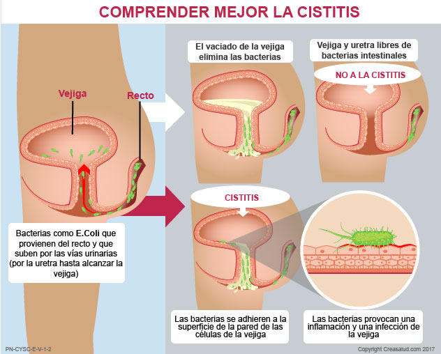 Causas De La Cistitis