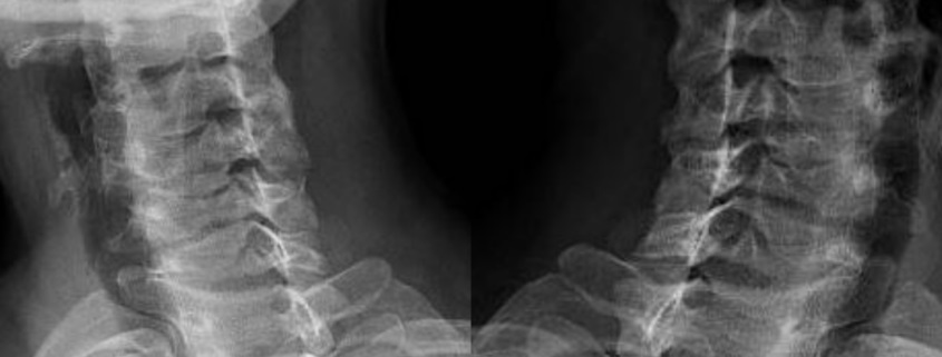 Causas De La Pérdida De La Lordosis Cervical