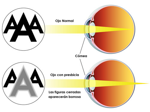 Causas De La Presbicia