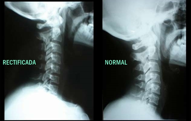 Causas Y Síntomas De La Rectificación De La Lordosis Cervical