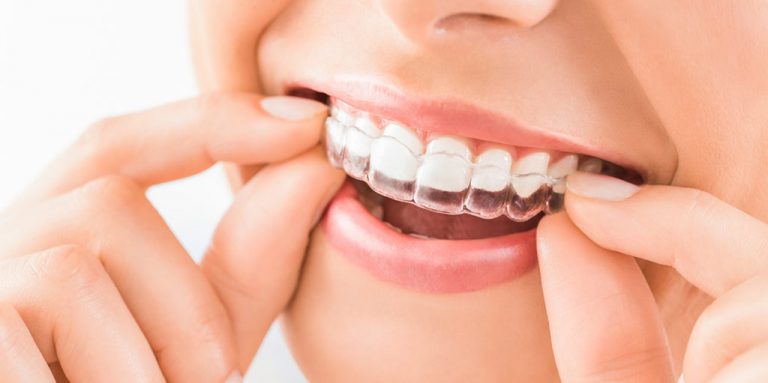 Ortodoncia invisible: qué es, cómo funciona y cuánto cuesta