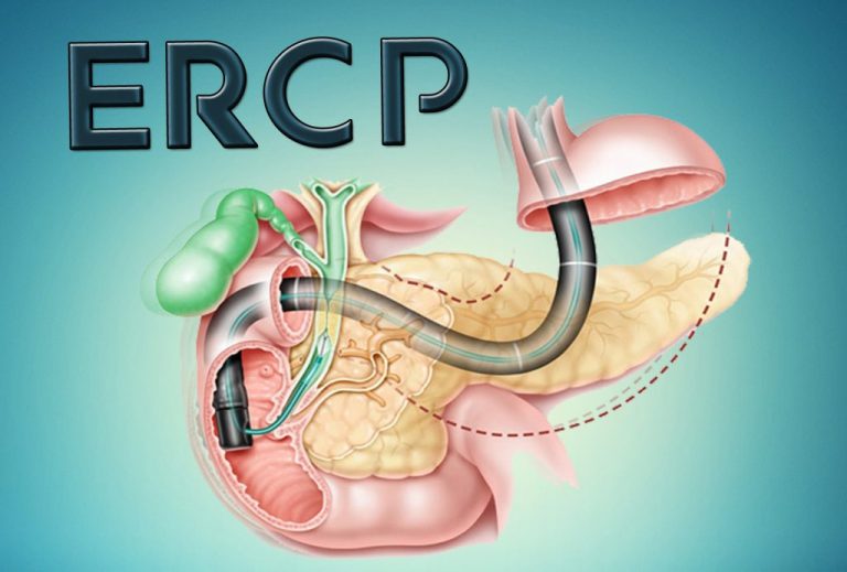 Qué es CPRE en medicina