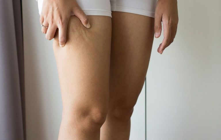 Qué es un lipedema