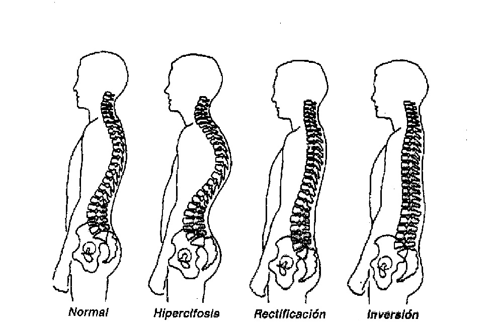 Tipos De Afecciones En La Columna