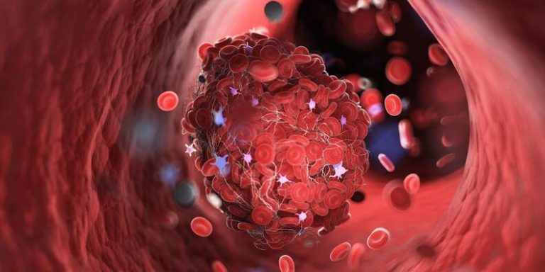 Una de cada 10-20 personas con cáncer desarrollará un tromboembolismo venoso