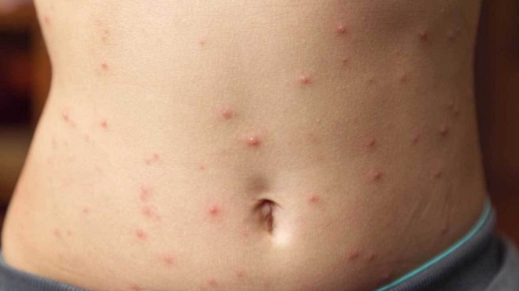 No Lo Elijas, Los Dátiles Pueden Causar Erupciones En La Piel
