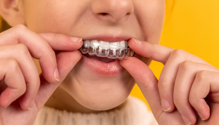 Clínicas dentales especializadas en tratamientos Invisalign