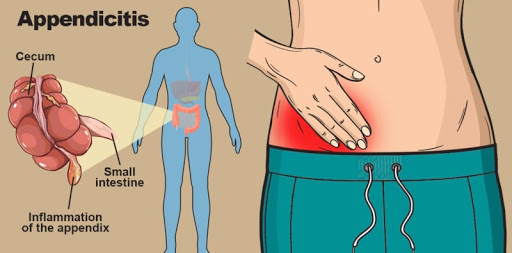 Apendicitis, Un Malestar Fuerte Que Puede Terminar Siendo Grave