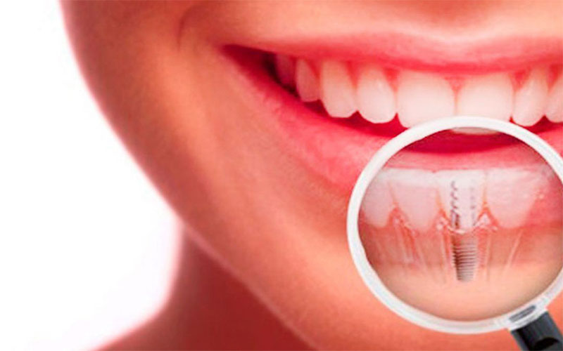 Funcionamiento Del Implante Dental