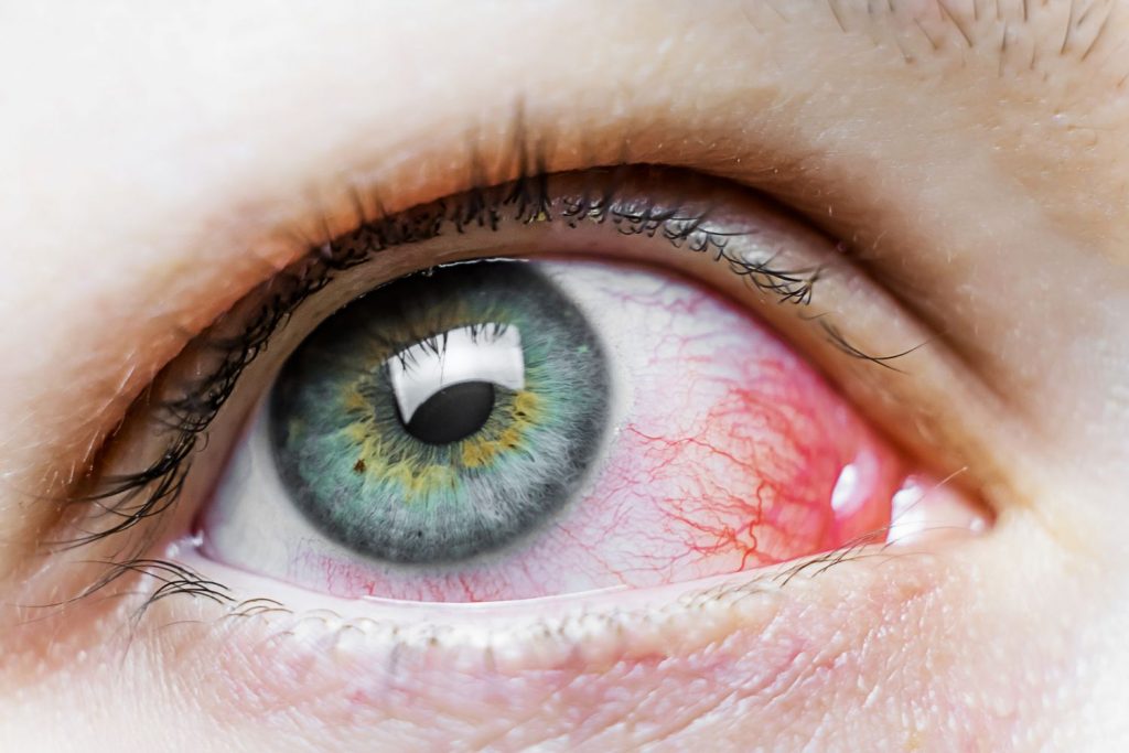 Infecciones En Ojos Y Mucosas