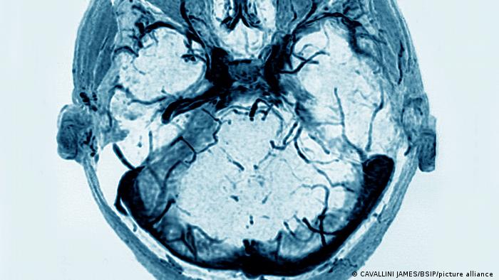La trombosis venosa cerebral en pacientes Covid puede asociarse a una respuesta inmunitaria