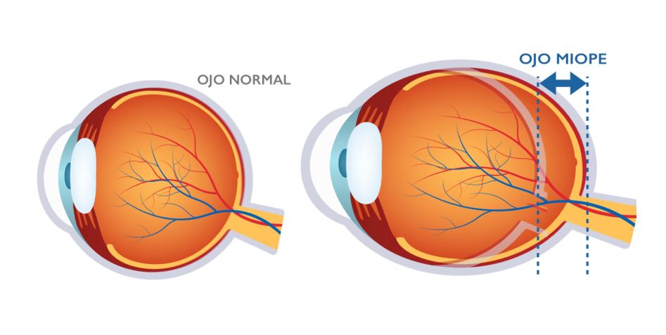 Qué Es La Miopía