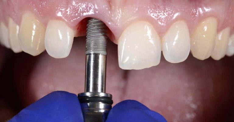 Qué es un implante dental
