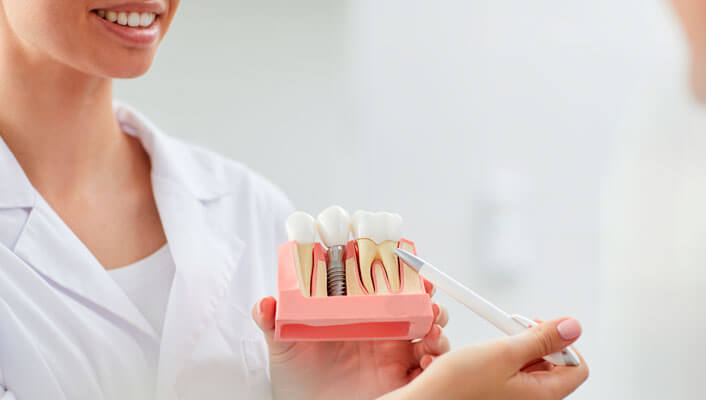 Tipos De Implante Dental