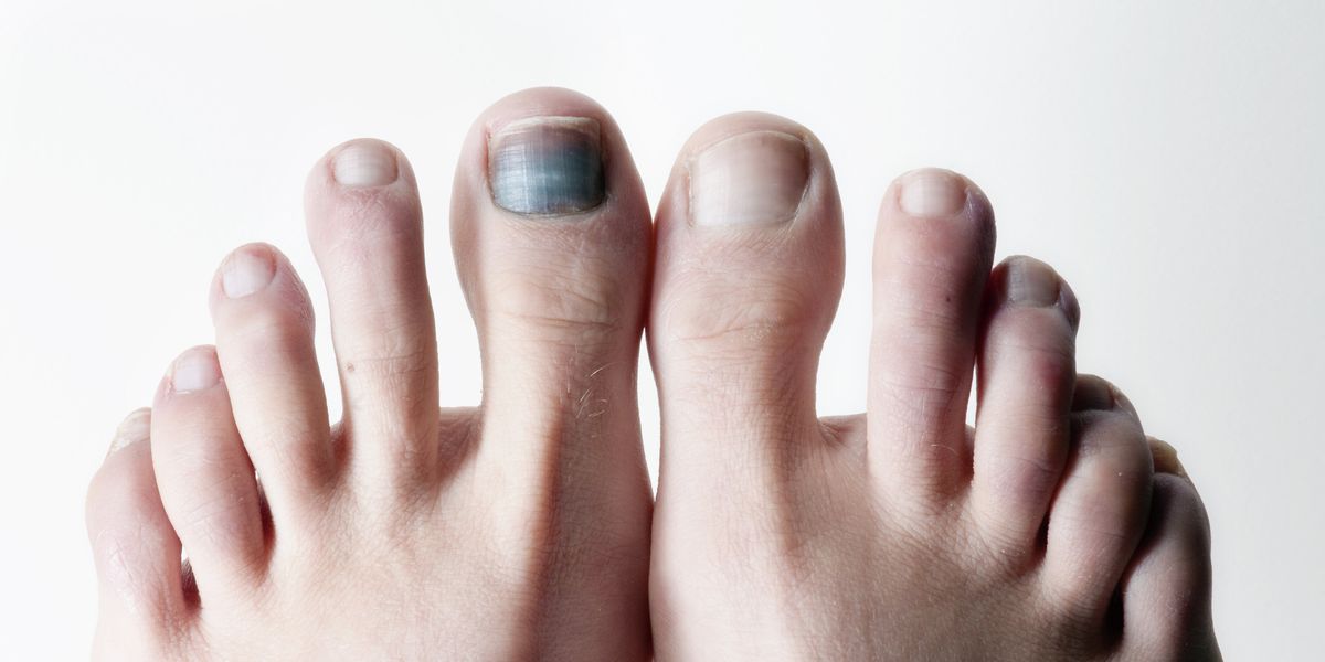 Uña del pie negra qué es causas y tratamiento Es grave