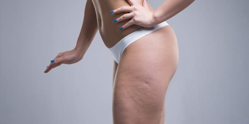 ¿Por Qué Aparece La Celulitis?