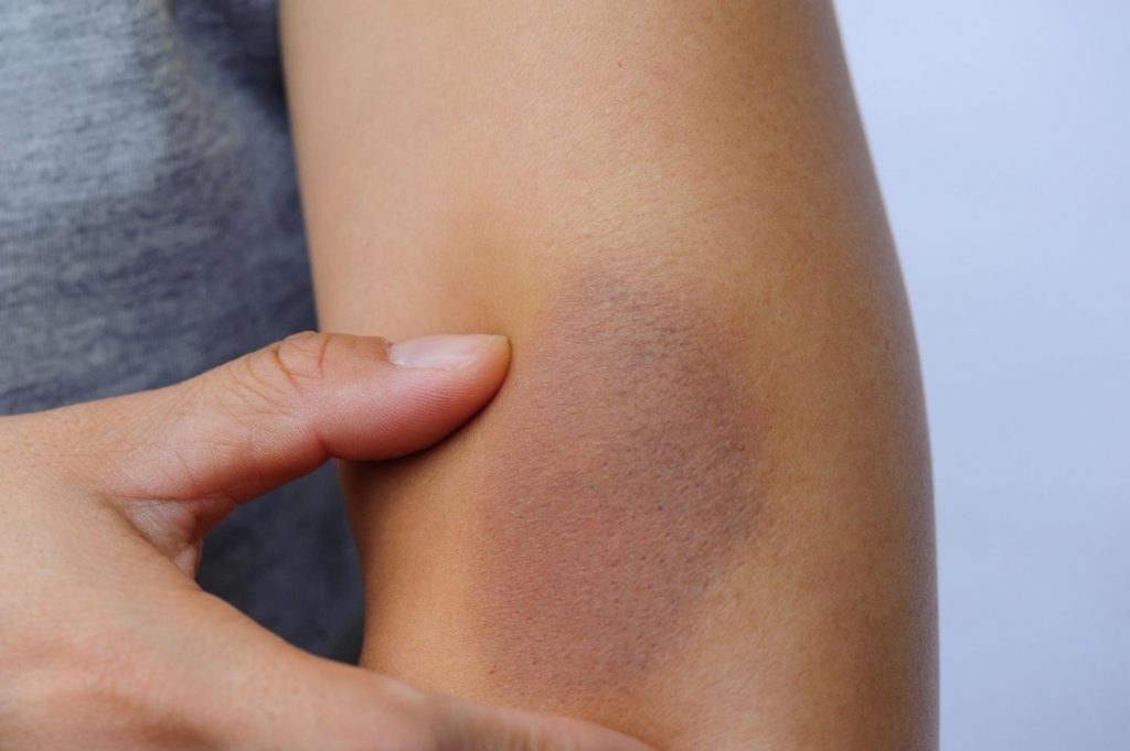 Hematoma