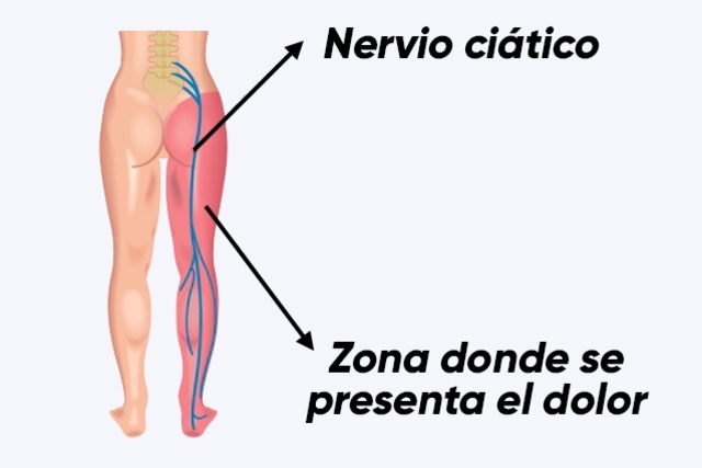 ¿Qué Se Hacer Cuando El Caso De La Ciática Es Grave?