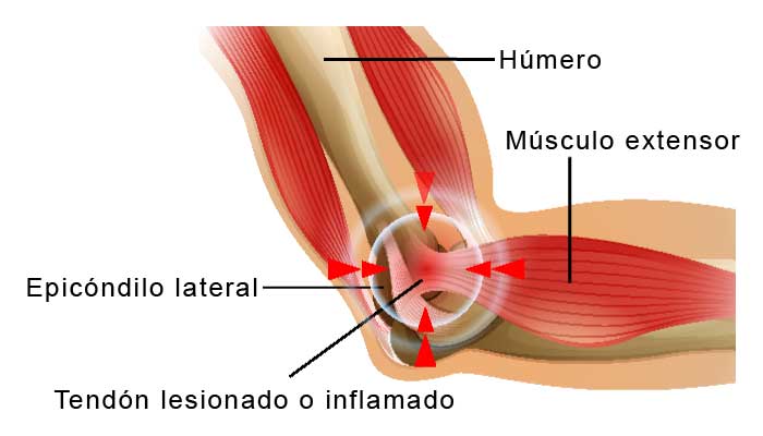 El Codo De Tenista, Un Mal Que Puede Atacar A Cualquiera 