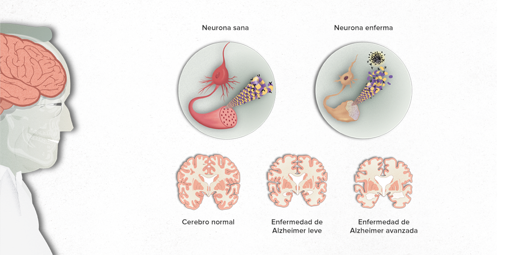 ¿Cómo Detectar El Alzheimer En Una Persona?