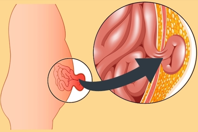 ¿Tener Una Hernia Abdominal Duele?