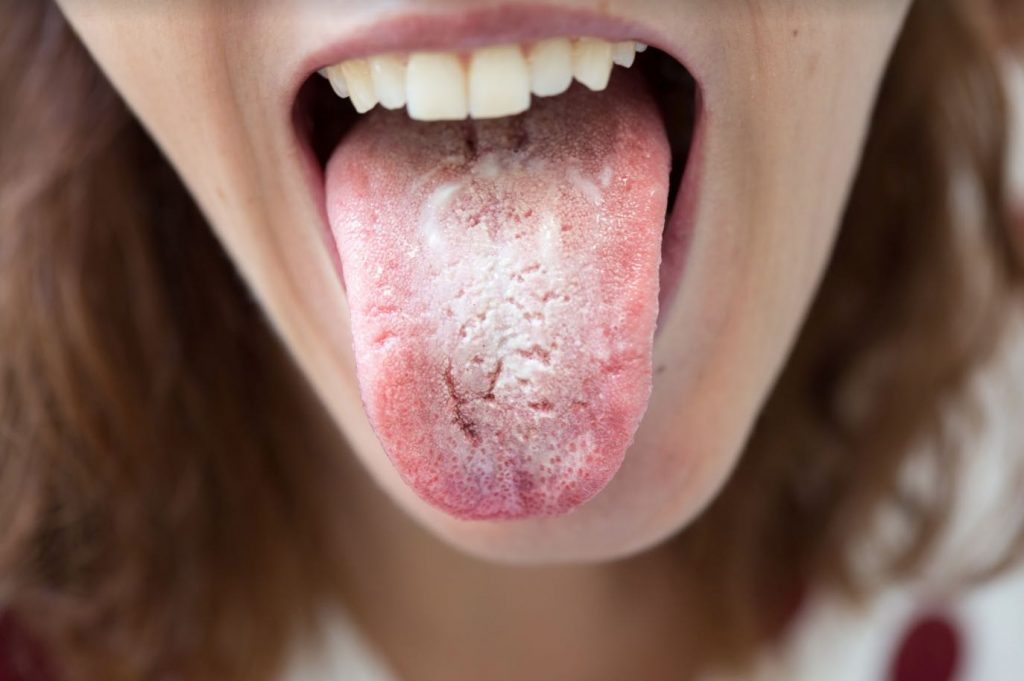Candidiasis