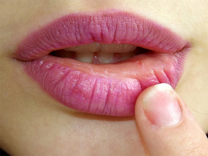 Herpes Enfermedades Beso