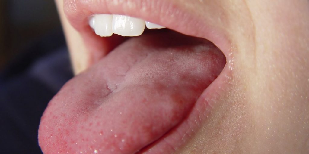 Mononucleosis Infecciosa Enfermedades Beso