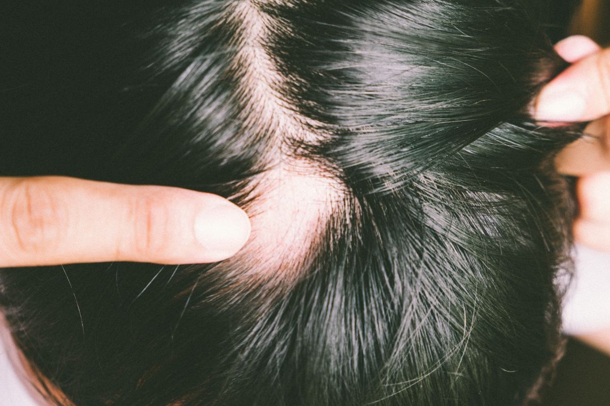 Qué Es La Alopecia 1 Qué Es La Alopecia