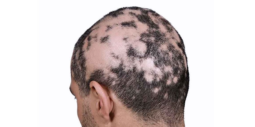 Qué Es La Alopecia