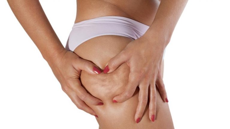 Qué es la celulitis