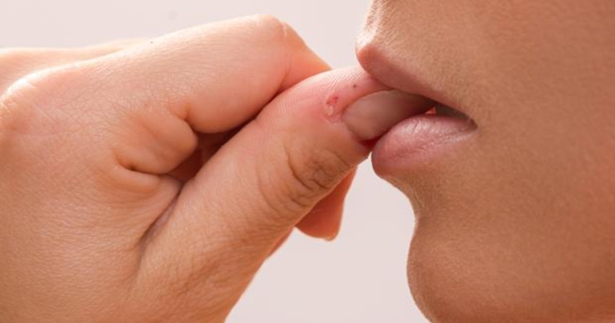 Qué Es La Dermatofagia 1 Qué Es La Dermatofagia
