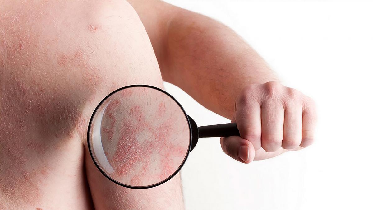 Qué Es La Psoriasis