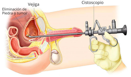 Qué Es Una Cistoscopia