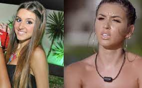 Blefaroplastia: Una Mejora Para Sus Ojos