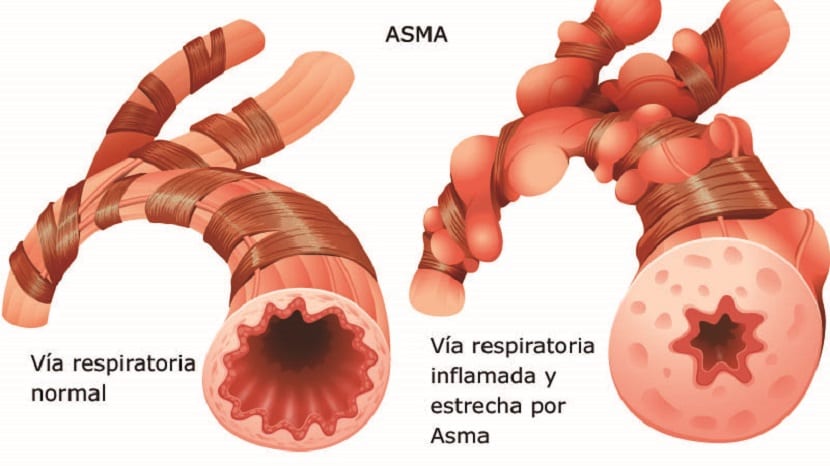 ¿Cómo Saber Si Padezco De Asma?
