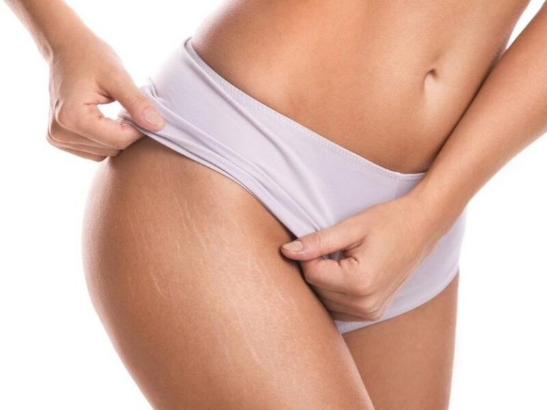 Estrías: por qué aparecen y cómo prevenirlas