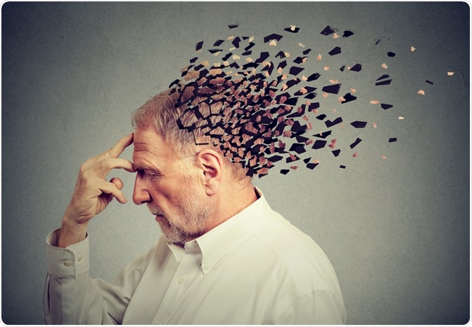 ¿Qué causa la enfermedad del Alzheimer?