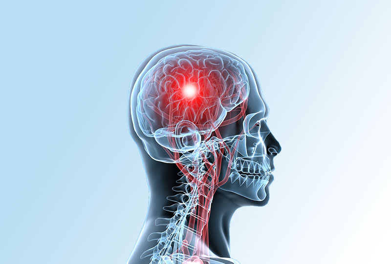 La Presencia De Ictus O Accidentes Cerebrovasculares