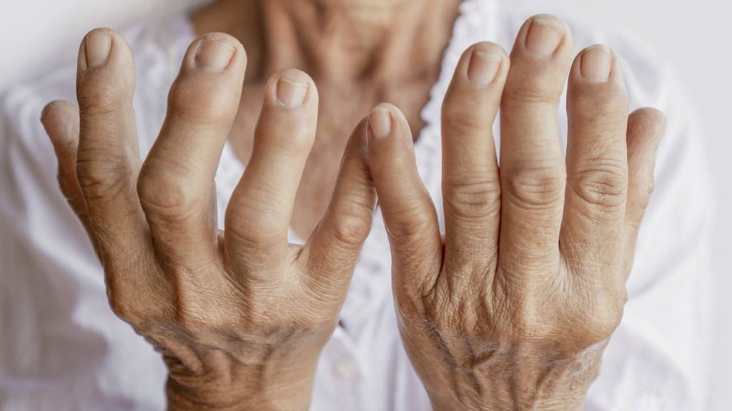 Personas Que Padezcan De Artritis