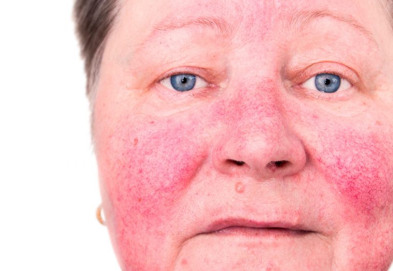 Qué es el lupus