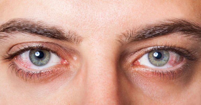 Qué es el síndrome del ojo seco